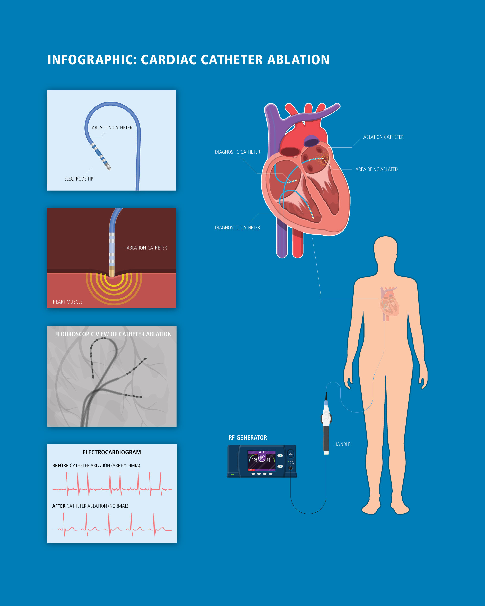 INFOGRAPHIC: Cardiac catheter ablation