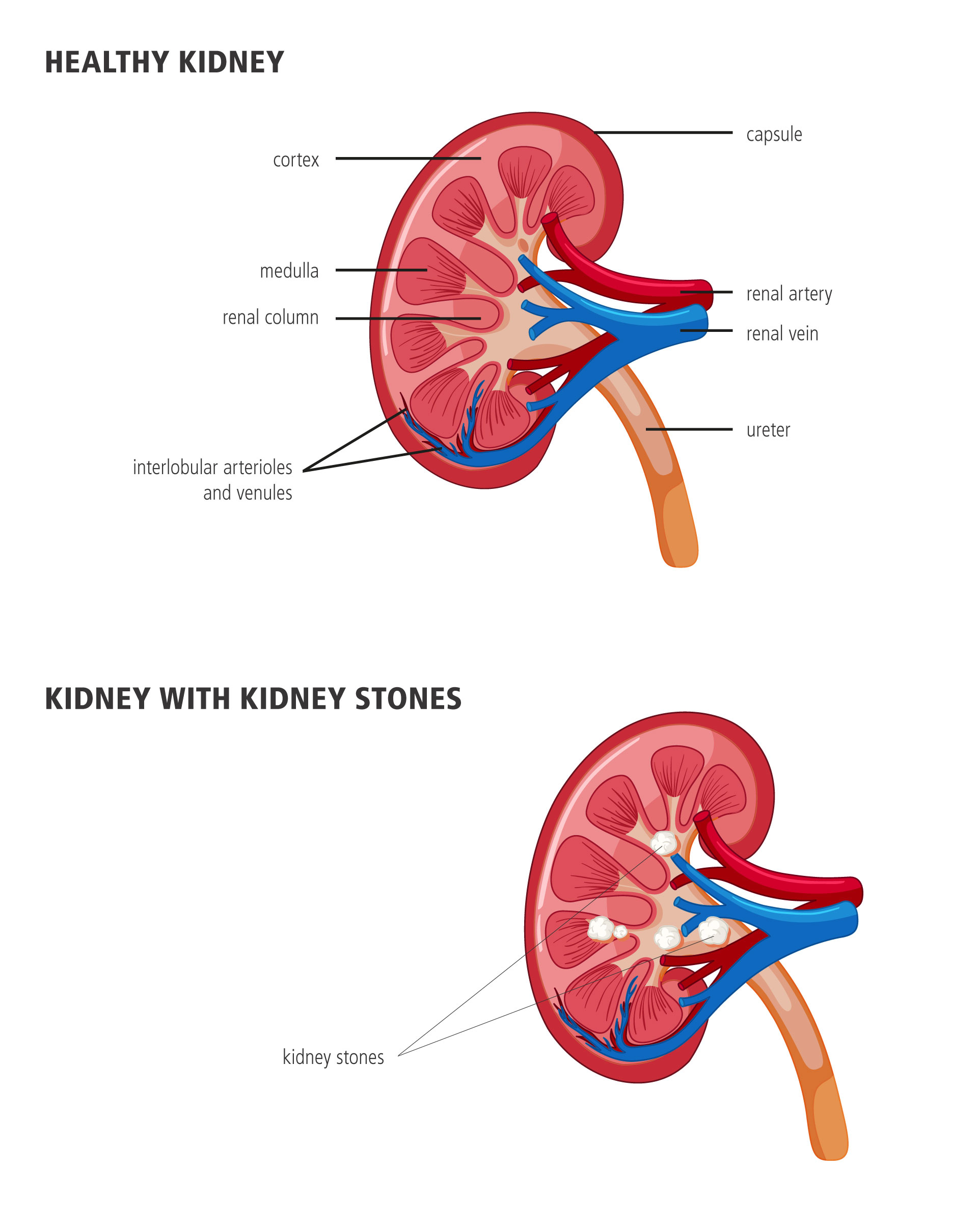 Healthy Kidney and Kidney with Kidney Stones
