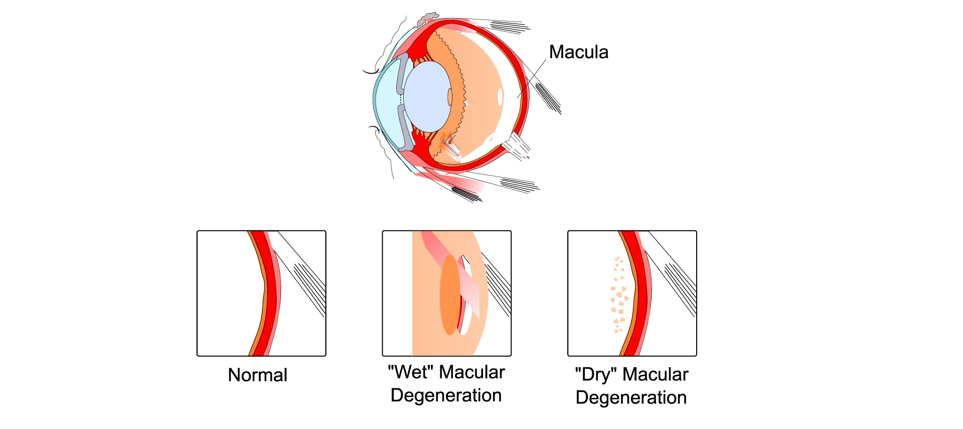 Age-related macular degeneration