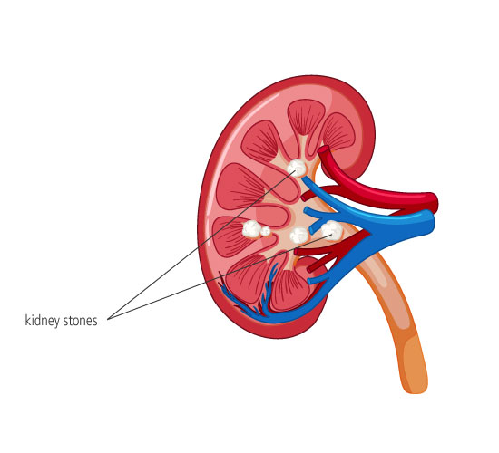 Combating kidney stones through prevention, treatment